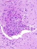 Granulomatous angiitis of the central nervous system
